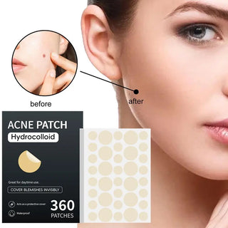 360PCS Eelhoe Acne Blemish Patch Sticker Waterproof Acne Treatment